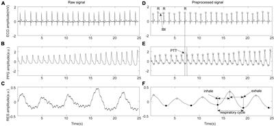 A study on the immediate effects of enhanced external counterpulsation on physiological coupling